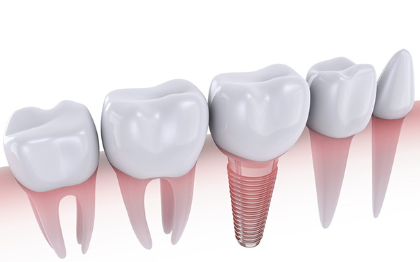 Dental Implants at Seolleung Station: One Choice Can Change the Next 10 Years image 2