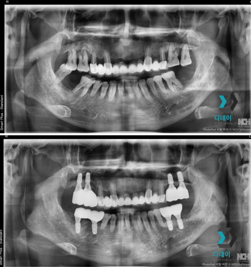 한티역치과 임플란트, 뼈이식 꼭 해야 할까? <의사 답변> 관련 이미지 5