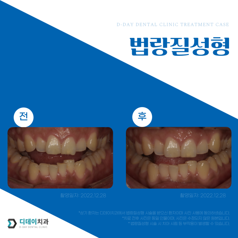앞니모양 개선할 수 있는 2가지 치아성형방법 관련 이미지 6
