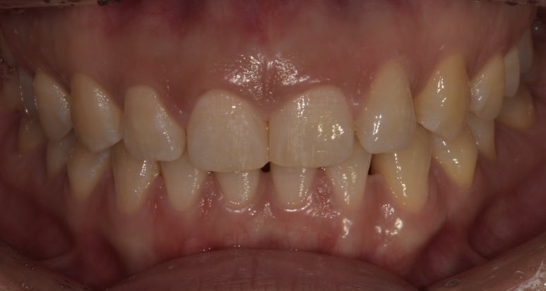 라미네이트 vs 레진 차이점 장단점 완벽 비교 관련 이미지 6
