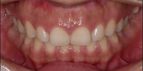 잇몸성형 비용, 통증, 회복기간, 후기까지 총정리 관련 이미지 6