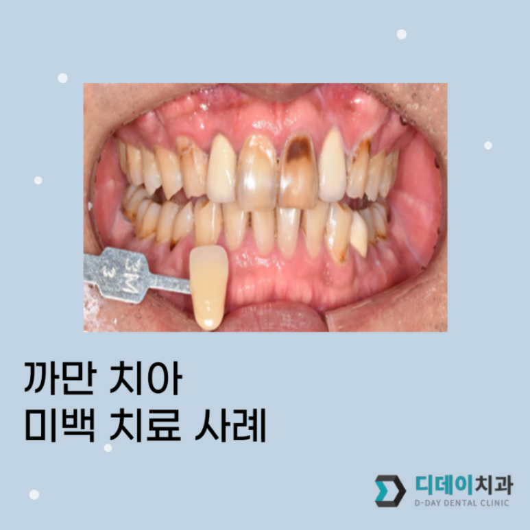 삼성역/대치동 치아미백? 변색된 치아 치료 사례 관련 이미지 1