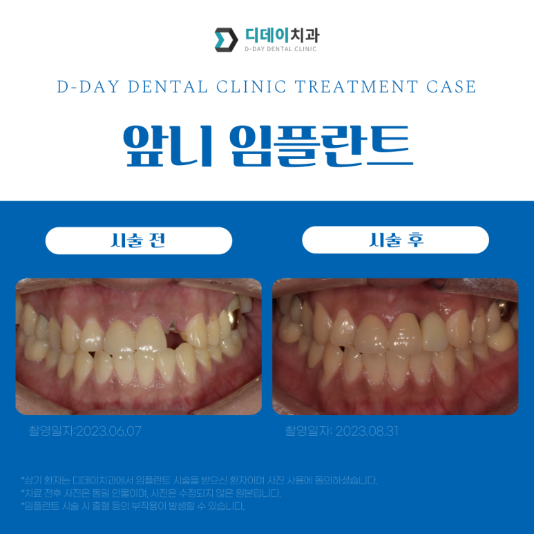 임플란트1개비용? 발품팔 필요 없이 이 글만 보시면 됩니다. 관련 이미지 4