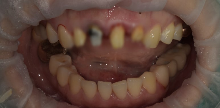 앞니브릿지교체? 브릿지를 크라운으로 교체 가능할까? 관련 이미지 5