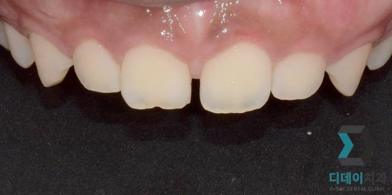 라미네이트후기, 치료사례만 모아 보여드립니다 관련 이미지 7