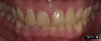 치아레진? 앞니, 치경부, 어금니 각 부위별 치료사례&비용 관련 이미지 4