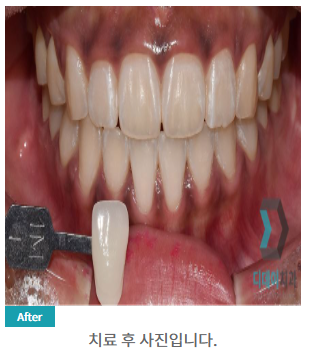 원데이 치과미백 치료? 5000건 해보고 알려드립니다. 관련 이미지 4