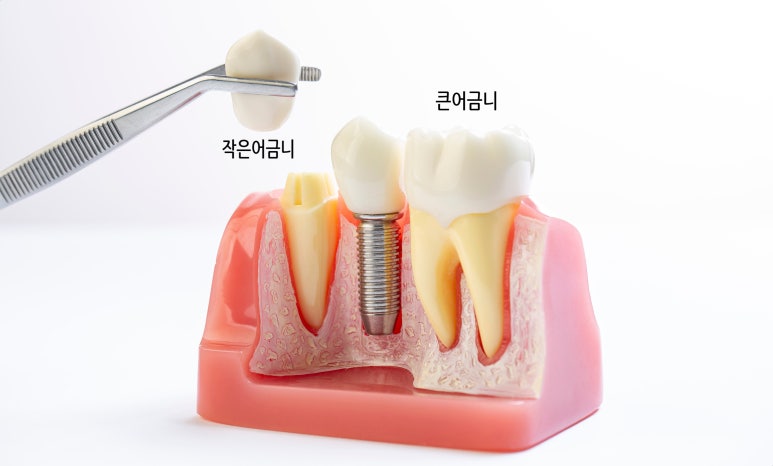 어금니 발치후 임플란트 기간? 식립 시기 모르면 후회합니다 관련 이미지 3