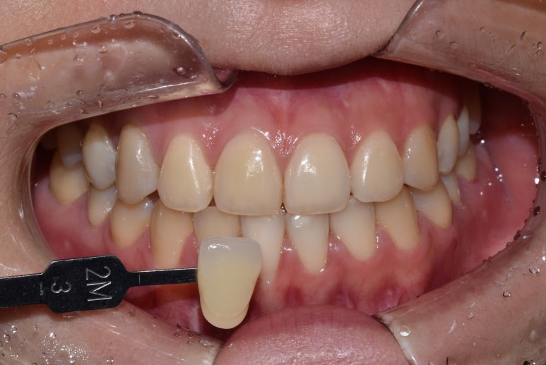 누렁니치아미백, 치료 사례로 보여드리는 개선 효과 관련 이미지 7