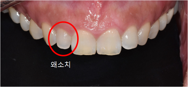 작은이빨, 왜소치? 치아 크기를 키우고 싶은 분만 <필독> 관련 이미지 1