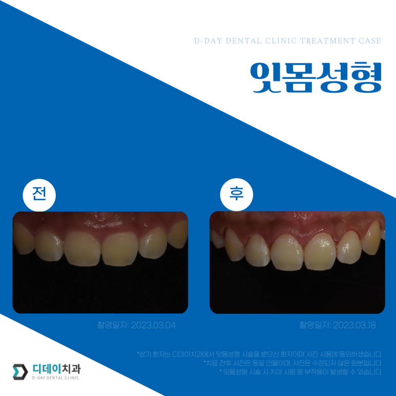 잇몸성형과 잇몸보톡스, 어떤 차이가 있는걸까요? 관련 이미지 6