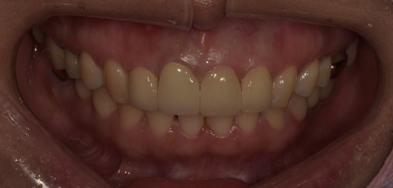 앞니브릿지교체? 브릿지를 크라운으로 교체 가능할까? 관련 이미지 6