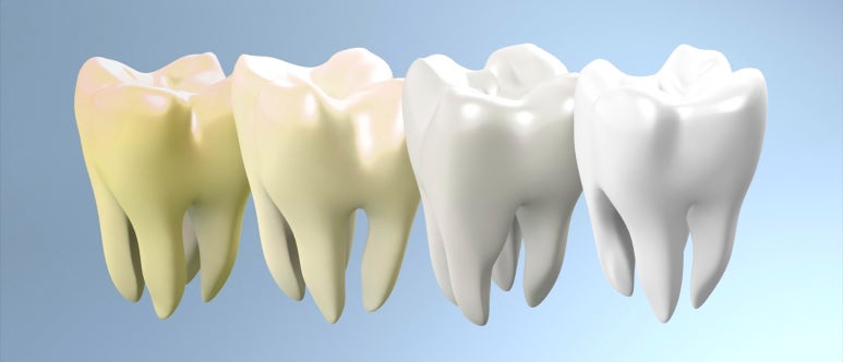 강남치아미백, 금세 또 착색되는 이유와 원데이 치료사례 관련 이미지 10