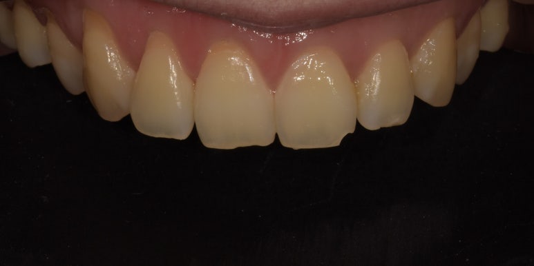 앞니깨짐, 레진? 크라운? 어떻게 치료할 수 있을까요? 관련 이미지 2