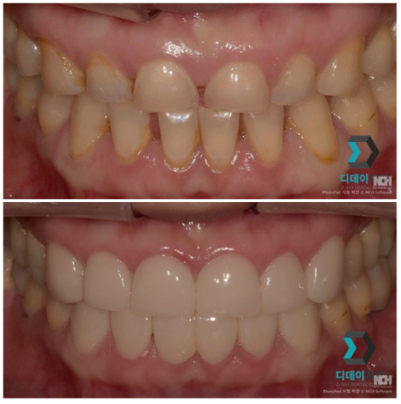 언주역치과추천 라미네이트, 자연치아 삭제량이 중요합니다 관련 이미지 3