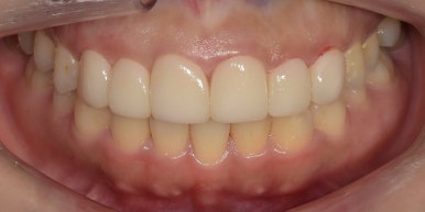 라미네이트 전후사진과 치료비용까지 숨김없이 알려드립니다. 관련 이미지 3