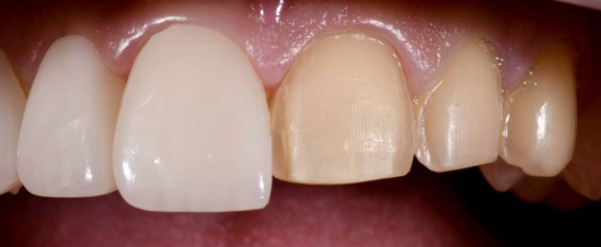 라미네이트 시술 전, 알아야할 3가지 꿀팁 관련 이미지 2