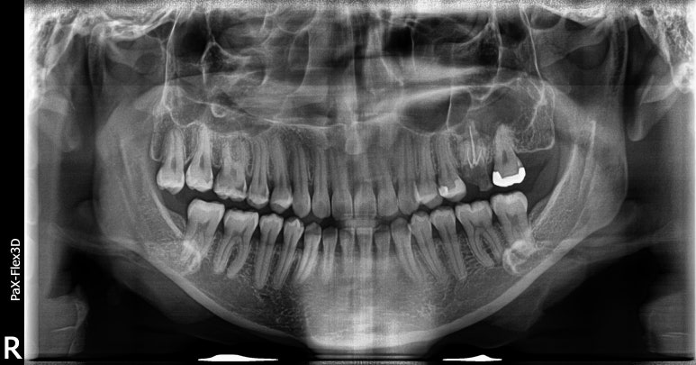 20대임플란트 수명? 평생 못쓸수도 있습니다. 관련 이미지 5