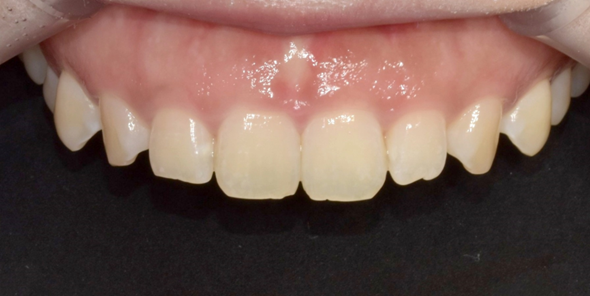 잇몸절제? 절개없이 레이저로 잇몸성형한 후기 관련 이미지 2