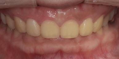 법랑질성형, 잇몸성형, 치아미백까지! 디데이치과 심미치료 총집합 치료사례 관련 이미지 8