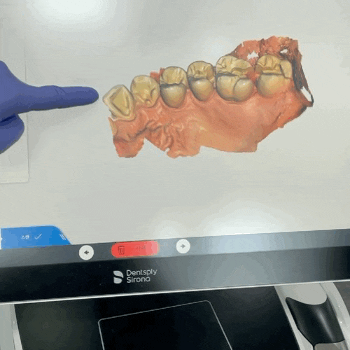 인레이수명, n년밖에 안된다구요? (feat. 적정한 인레이가격은?) 관련 이미지 4