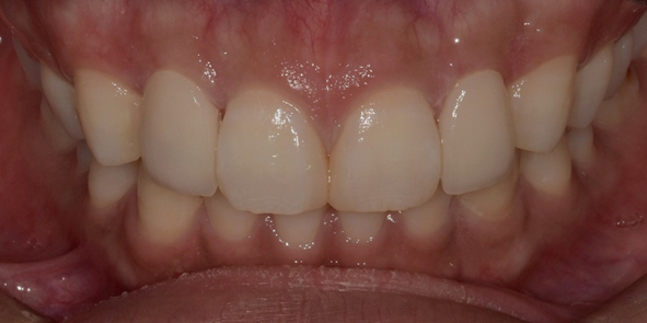 라미네이트, 치아보험 적용이 가능할까요? 관련 이미지 8