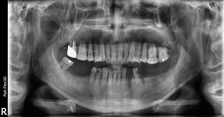 임플란트건강보험, 추가비용 없이 가능할까요? 관련 이미지 5