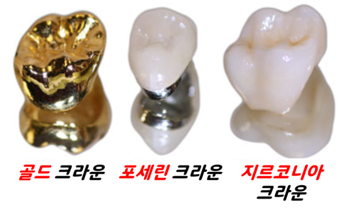 치아 신경치료 안하고 버티면? 관련 이미지 3