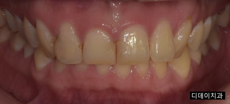 치아레진? 앞니, 치경부, 어금니 각 부위별 치료사례&비용 관련 이미지 3