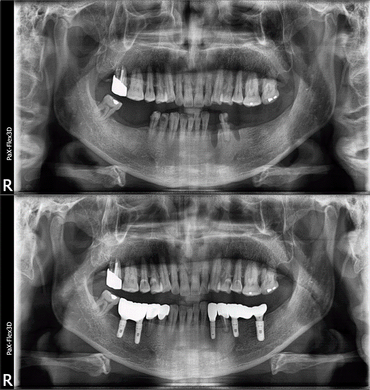 고령자임플란트 보험 적용받을 때 주의할 점 관련 이미지 4