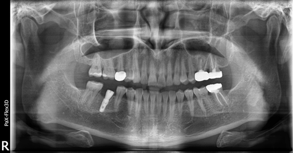 어금니임플란트, 당일식립한 사례부터 비용까지 관련 이미지 5