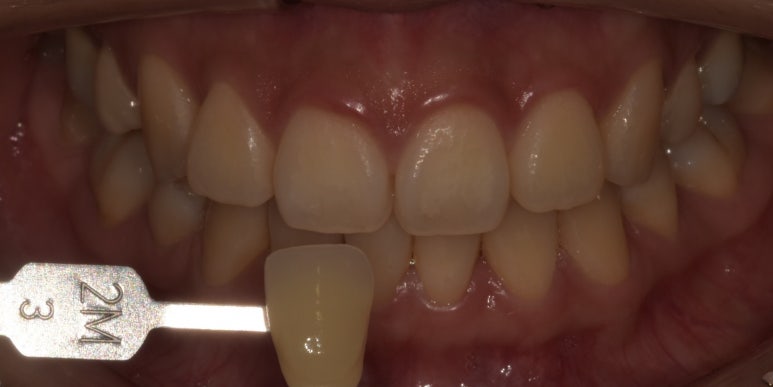 치과치아미백, 전후사진과 치료비용이 궁금하다면? 관련 이미지 3