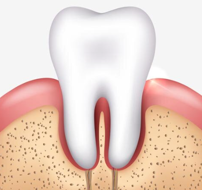 잇몸 부으면 치석 때문? 치아 흔들림의 이유 관련 이미지 2