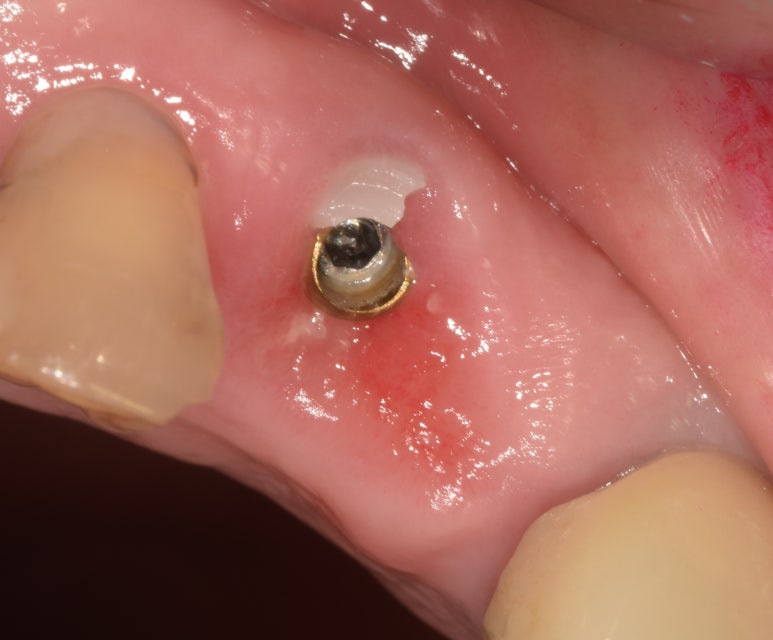임플란트깨짐, 단순한 문제가 아닐 수 있습니다. 관련 이미지 1