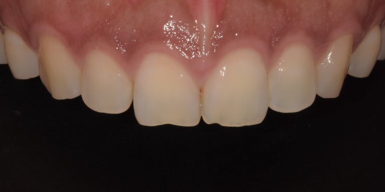 치아성형비용, 비싼 것만은 아닙니다. 관련 이미지 2