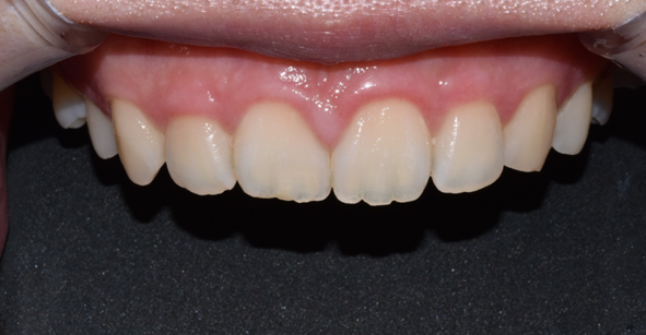 치은절제술/성형술? 잇몸이 치아를 덮고 있어 고민인 분만 관련 이미지 3