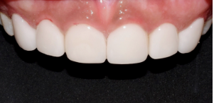 연예인잇몸성형? 시술 전 확인하세요. 관련 이미지 4