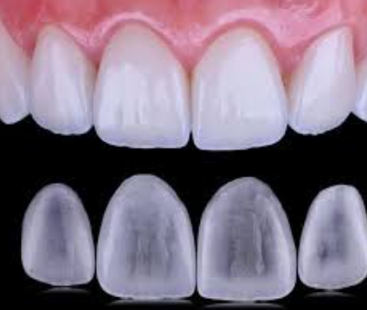 라미네이트 제거, 후기만 보고 가면 안되는 이유 - 의사 작성 관련 이미지 4