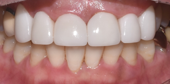 앞니성형? 치아만 바뀌어도 달라지는 이미지 (대공개) 관련 이미지 7