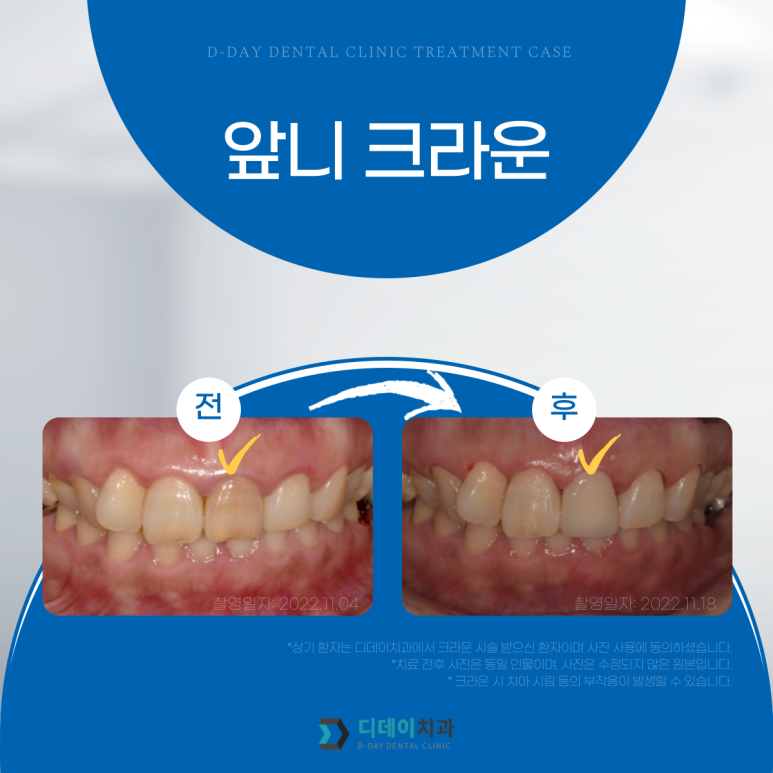 앞니크라운, 라미네이트 같이 하면 티날까? 사진으로 증명합니다. 관련 이미지 8