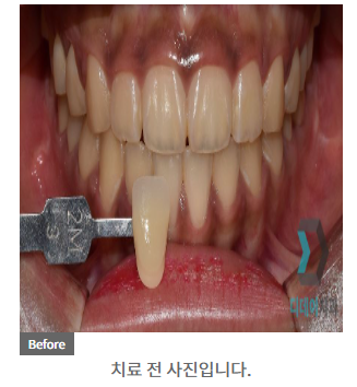 프로필 촬영 전 치아미백 꼭 필요할까요? 관련 이미지 5