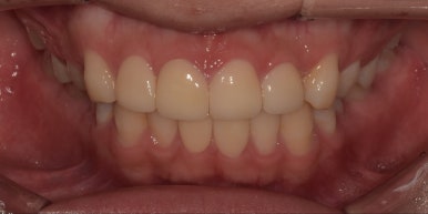 라미네이트 전후사진과 치료비용까지 숨김없이 알려드립니다. 관련 이미지 5