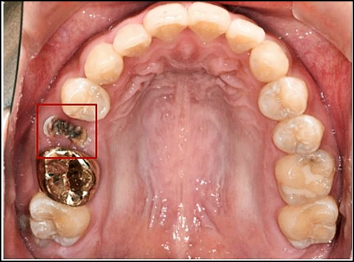 치아 크라운 수명, 끝까지 쓰는 방법 1가지 관련 이미지 1