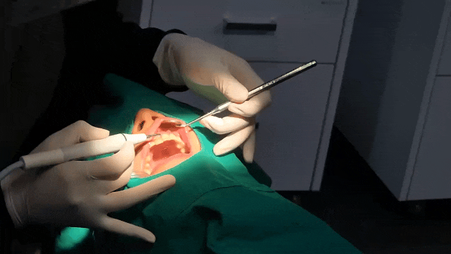 강남구청역치과, 임플란트 저렴한 곳만 찾으시면 안됩니다 관련 이미지 10