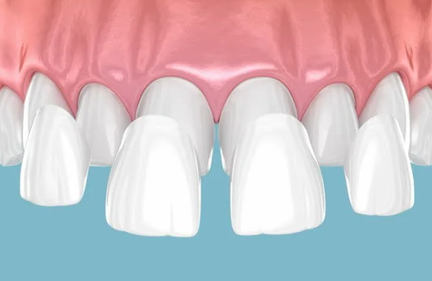 라미네이트 후회하시는 분들 공통점 3가지 관련 이미지 4
