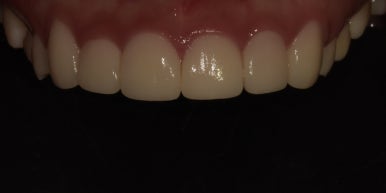 교정없이 라미네이트로 치아배열 개선? 앞니 12개 케이스 공개 관련 이미지 8