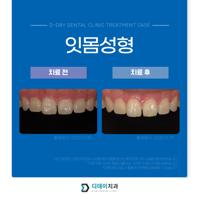 잇몸성형 비용과 자주묻는 질문 답변까지 이 글로 정리합니다. 관련 이미지 5