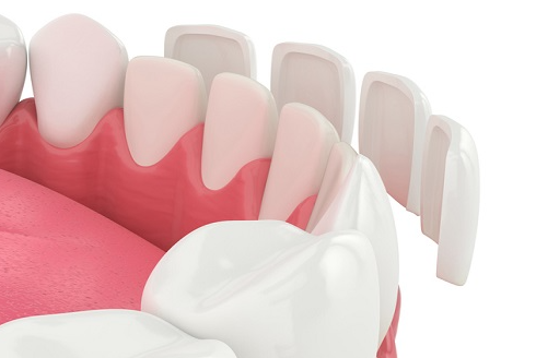 라미네이트 비용, 가격만 보다가 100만원 손해봅니다 관련 이미지 4