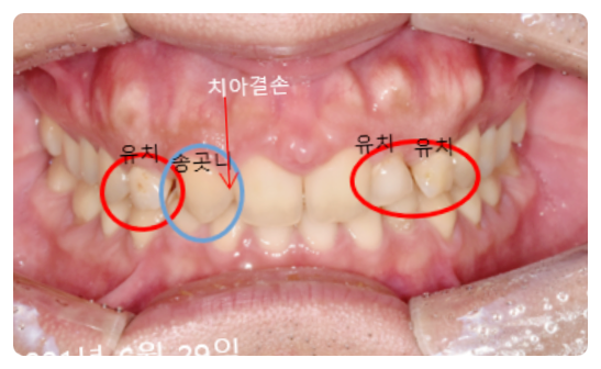 앞이빨임플란트? 3가지 원칙부터 확인하세요. 관련 이미지 1