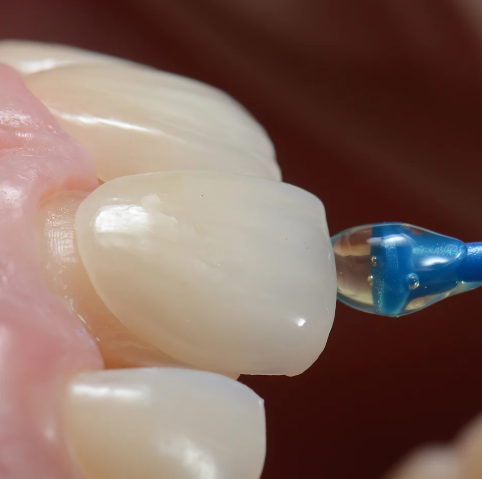 라미네이트 레진, 덤탱이를 피하려면 꼭 보세요 관련 이미지 3